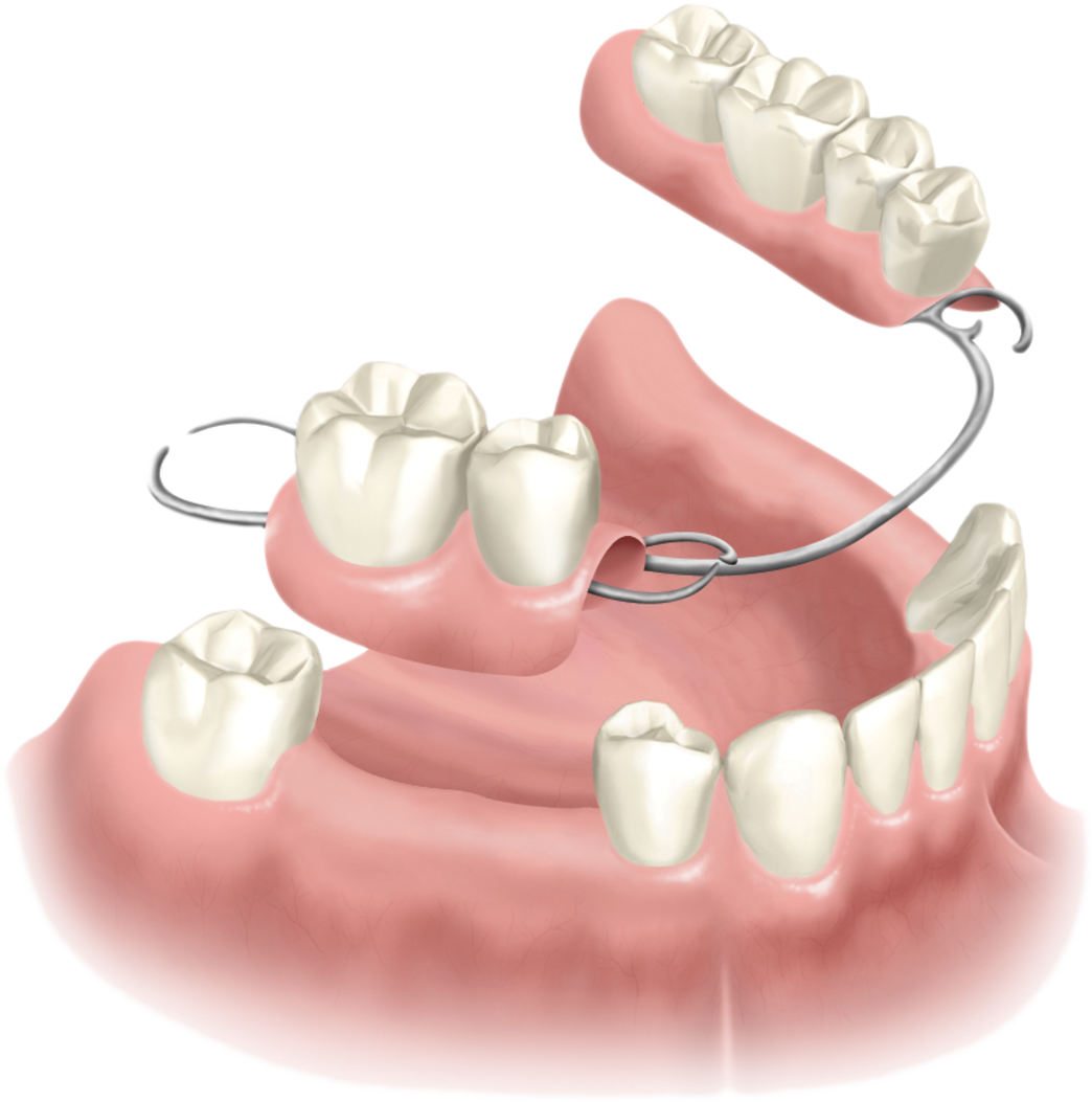 Partial Dentures Windsor Ct Removable Dentures