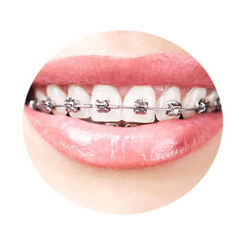 What If I Don't Want Metal Braces?
